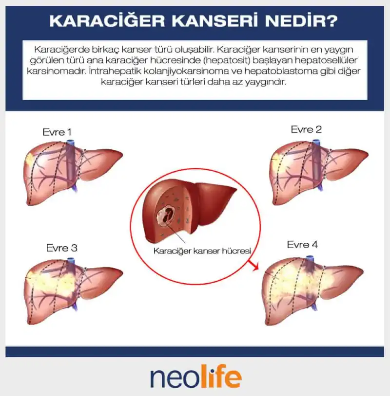 Testis kanser Testicular cancer